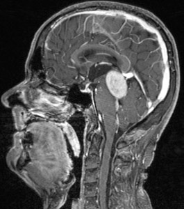 miniggioma-opisthiou-ogkou